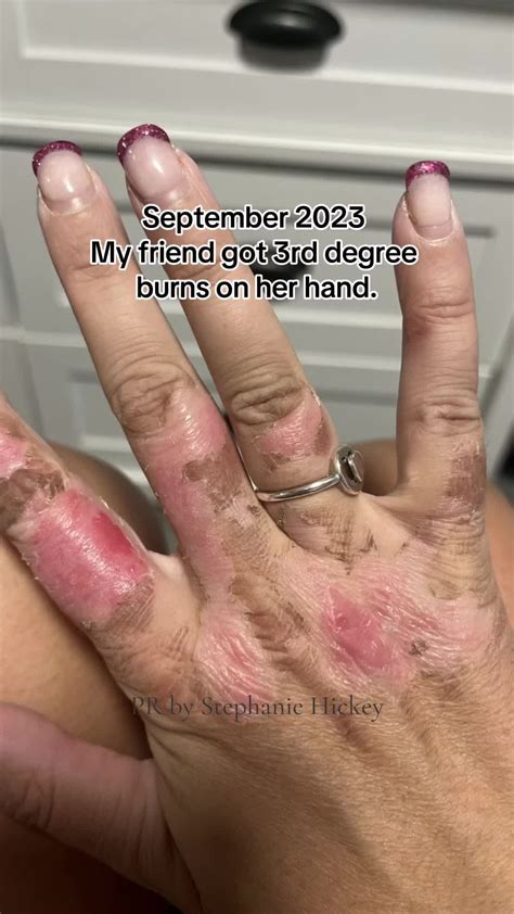 how to care for third degree burns