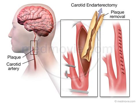 Carotid Artery Surgery – Medmovie.com