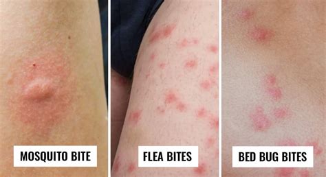 Bed Bug Bites Vs Mosquito Bites