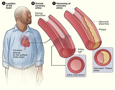 clogged arteries  symptoms signs treatment  prevention