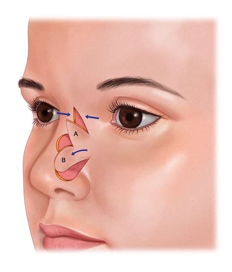 Lentigo maligna and lentigo maligna melanoma – Artofit