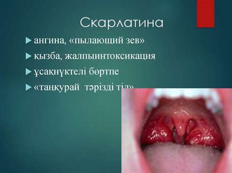 Балалардағы бөртпе синдромымен жүретін аурулар - презентация онлайн