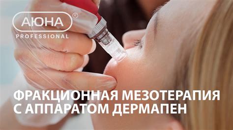 Фракционная мезотерапия. Процедуры на лице, техники работы. - YouTube