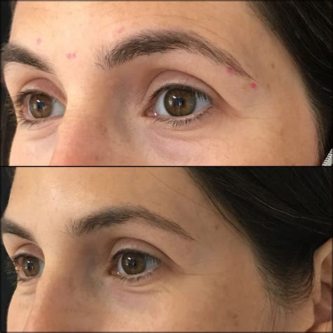 Botox Before And After Eyebrow Lift