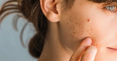 Alergia A Glúten No Rosto - Sintomas De Alergia Alimentar No Rosto Alergia Alimentar? O Rosto Fica