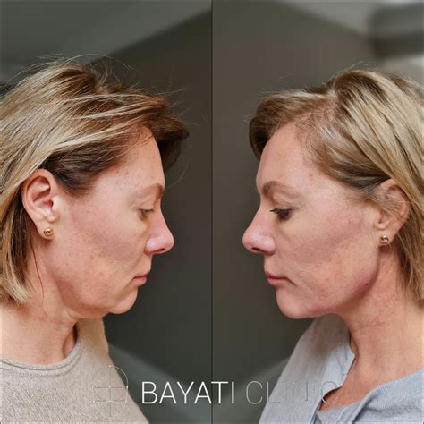 Endolift Antes E Depois