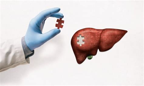 Da Pra Viver Sem Figado - É possível viver sem o fígado? - Dr. Tiago Emanuel | Cirurgião do ...