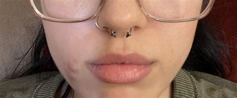 Vertical Labret Scar
