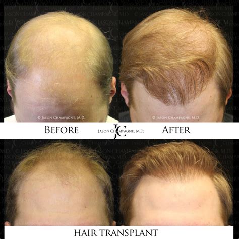 dr champagnes hair transplant redefining hair restoration