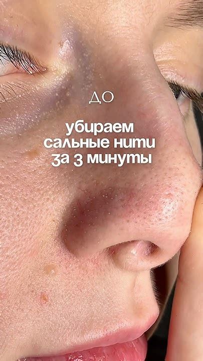 Глубокое очищение пор от сальных нитей и черных точек!Арт 139625239 ...