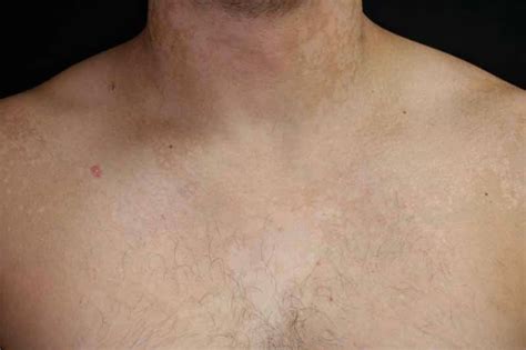 Tinea Versicolor Before And After