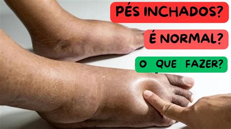 Como Desinchar O Pé Na Gravidez - Pés INCHADOS no PÓS PARTO - PORQUE ISSO ACONTECE - COMO DESINCHAR OS ...