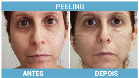 Peeling De Diamante Antes E Depois 1 Sessão - Benefícios Do Peeling - O Melhor Tratamento Em 2026