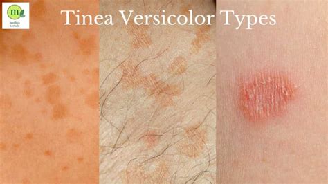 Tinea Versicolor: Complete Ayurvedic Treatment that will Cure Fast