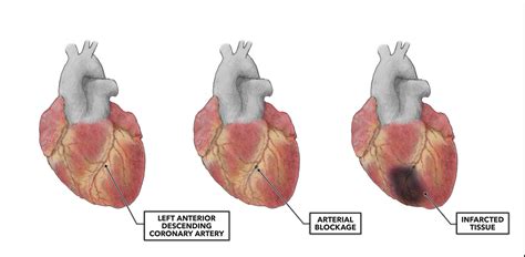 Myocardial Infarction Photo