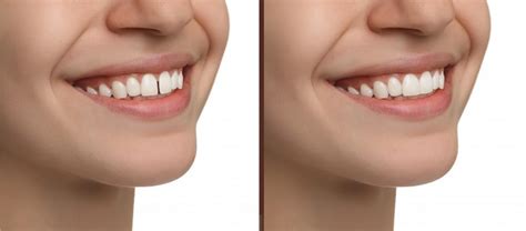 gaps   teeth dangerous smile design manhattan cosmetic
