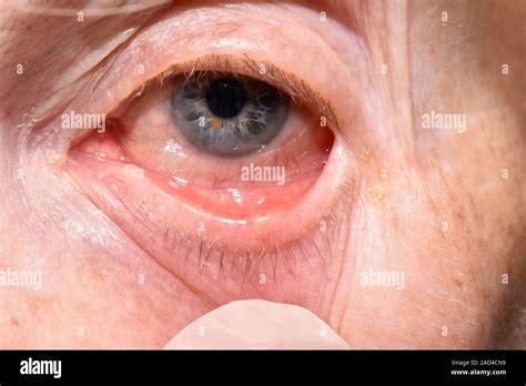 meibomian cyst close    meibomian abscess    eyelid