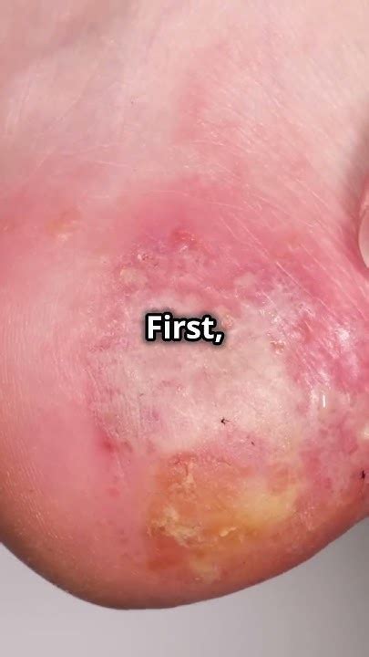 How to Spot Giant Jiggers in Your Feet! - YouTube