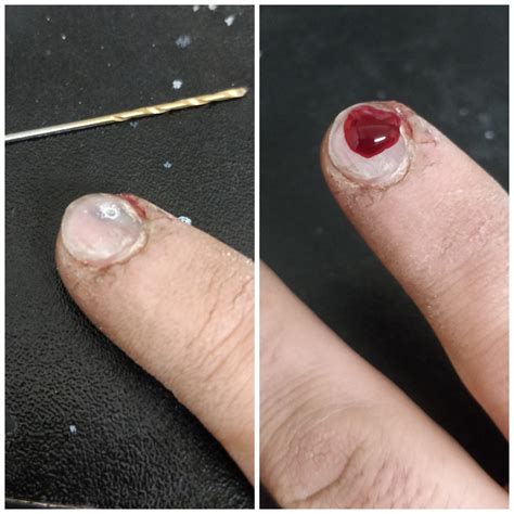 Subungual Hematoma Can Cause at Anna Mcgraw blog