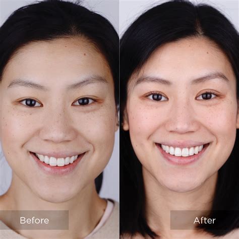 Invisalign Face Shape Before And After - dailymigrants.com