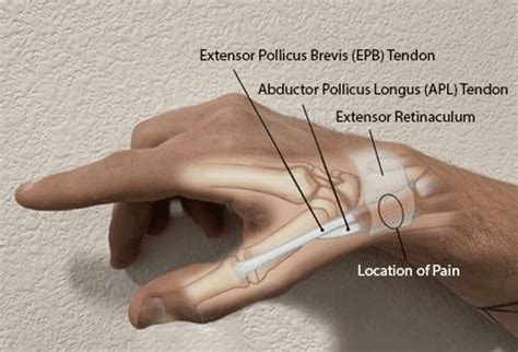 De Quervain S Tenosynovitis Thumb | Images and Photos finder