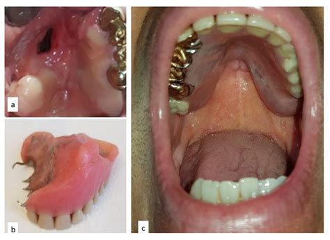 Topical Imiquimod: Effectiveness In Intraepithelial, 51% OFF