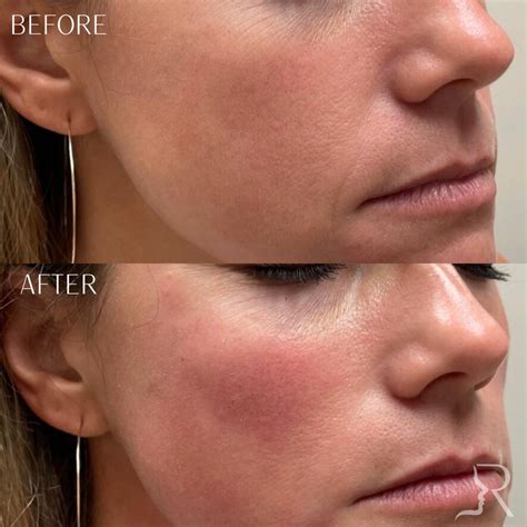 Cheek Fillers Before and Afters | Roberts Aesthetics and Wellness