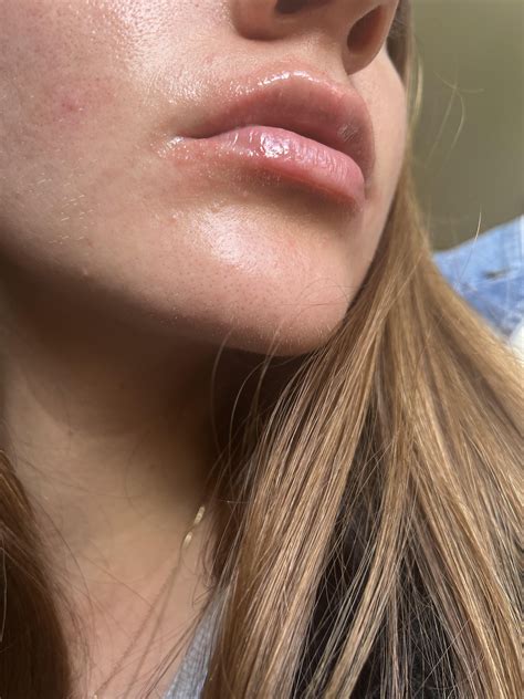 Persisting lip rash for 2+ months : r/DermatologyQuestions
