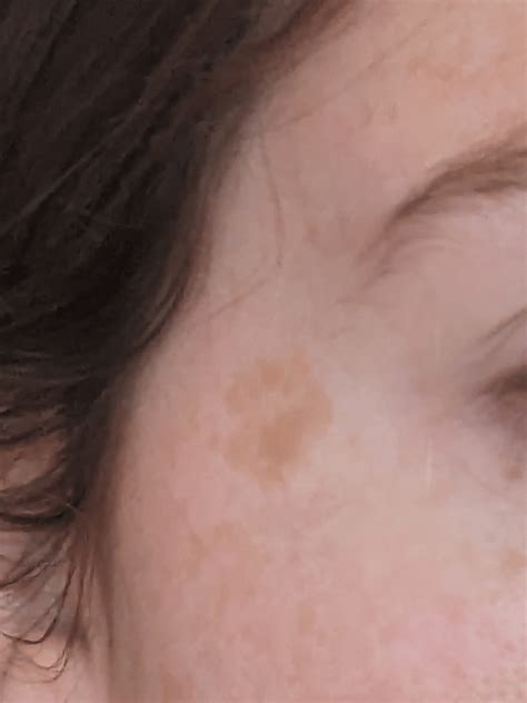 Going to the Drs next Tuesday. This has been growing. 😅 Face freckle
