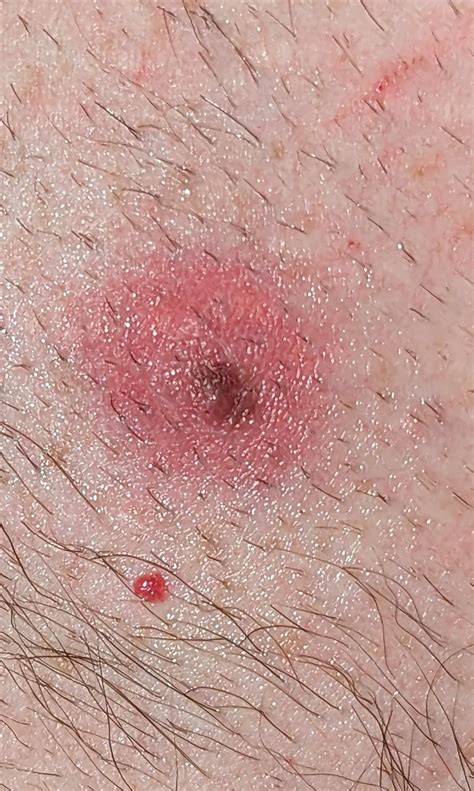 red rash surrounding existing mole   regression rmelanoma