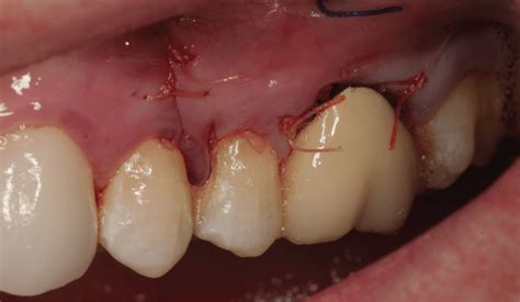 root amputation pocket dentistry