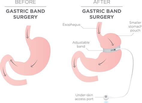 Gastric Band - Dr. John Makipour