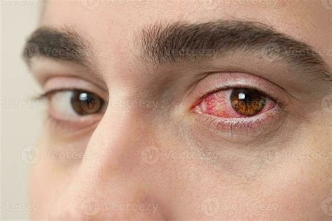 Bloodshot Eyes Stock Photos, Images and Backgrounds for Free Download