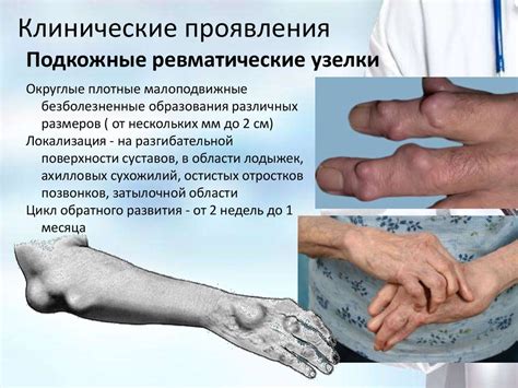 Острая ревматическая лихорадка - презентация онлайн