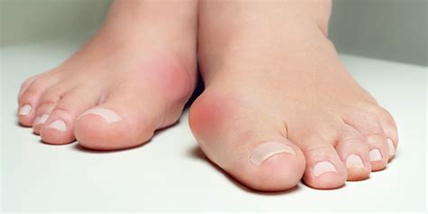 deformities benenati foot  ankle care centers
