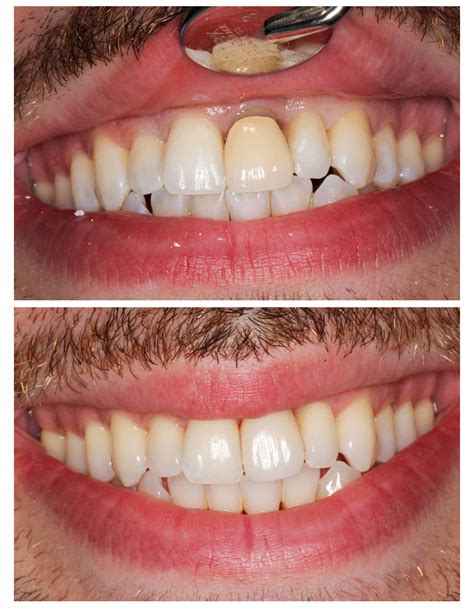 dental inlays onlays  crowns porcelain crowns nyc dentist