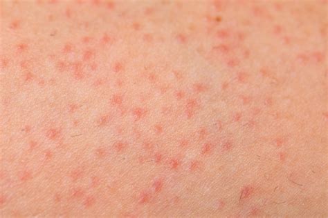Hair Loss - Auckland Skin Clinic