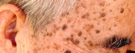 Benign Lesions | Skin Tag and Mole Removal | Birmingham Medical Spa