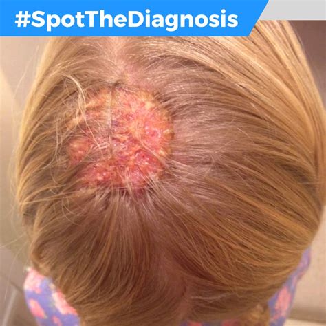 Couro Cabeludo Impetigo