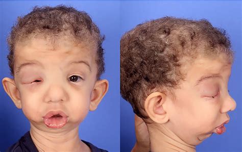 preoperative photo   patient showing significant periorbital