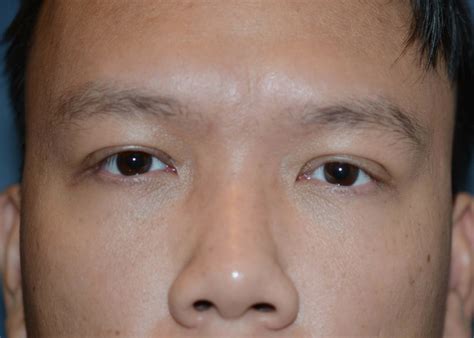 Double Eyelid #0560 - Amadi Aesthetics | Plastic Surgery & Med SPA