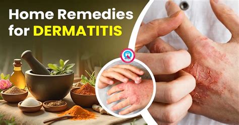 home remedies  dermatitis soothe  skin naturally