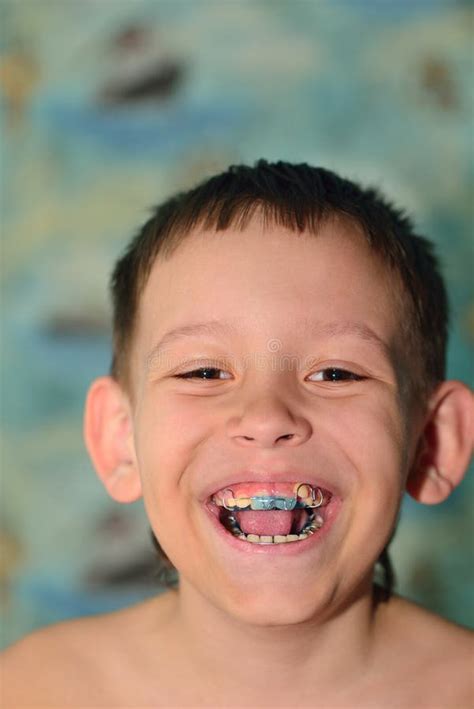 A child with braces smiles stock photo. Image of people - 102039704