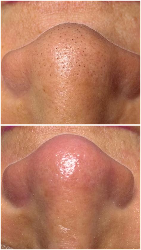 The utube blackheads clip that reached a billion views 8