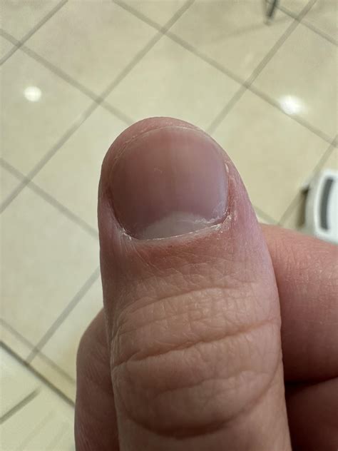 Should I be worried about this? : r/Melanoma