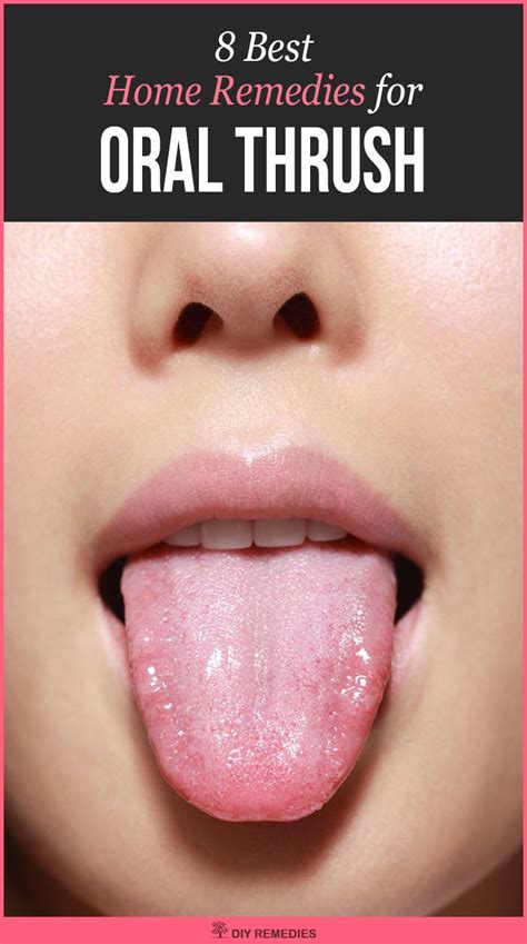Home Remedies for Oral Thrush Here are some best natural remedies that ...