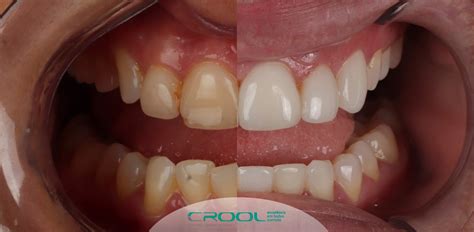 O'que É Facetas De Resina - Facetas de resina: Uma forma prática de transformar o seu sorriso - CROOL