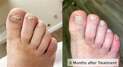Laser Toenail Treatment | NEW TREAD PODIATRY PLLC