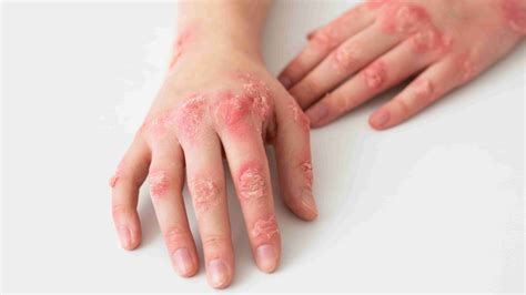 Dermatitis - Saavya Dermatology & Laser Clinic