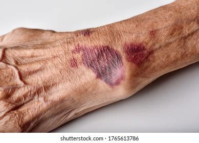 1,076 Elderly Bruise Images, Stock Photos & Vectors | Shutterstock